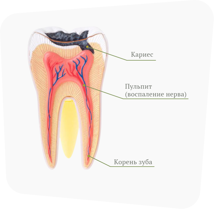 Осложнения лечения пульпита. Строение зуба кариес пульпит. Строение молочного зуба пульпит.